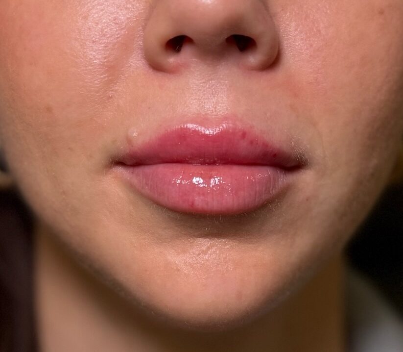 Favorite Day Lips injections by Stina at Favorite Day Aesthetics